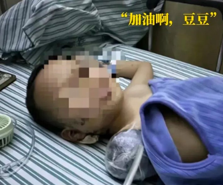 江西6岁男孩被鞭炮炸伤致使截肢，已经历四次手术
